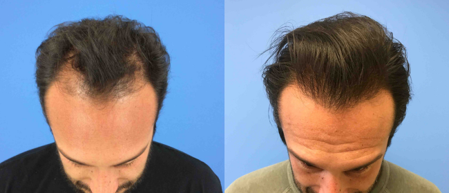 CosmetiCare's tweet photo. Before and after of Hair Restoration ✨

Schedule your consultation with one of our Board-Certified plastic surgeons today by calling 949-446-1542! https://t.co/M7gJlxzw0c