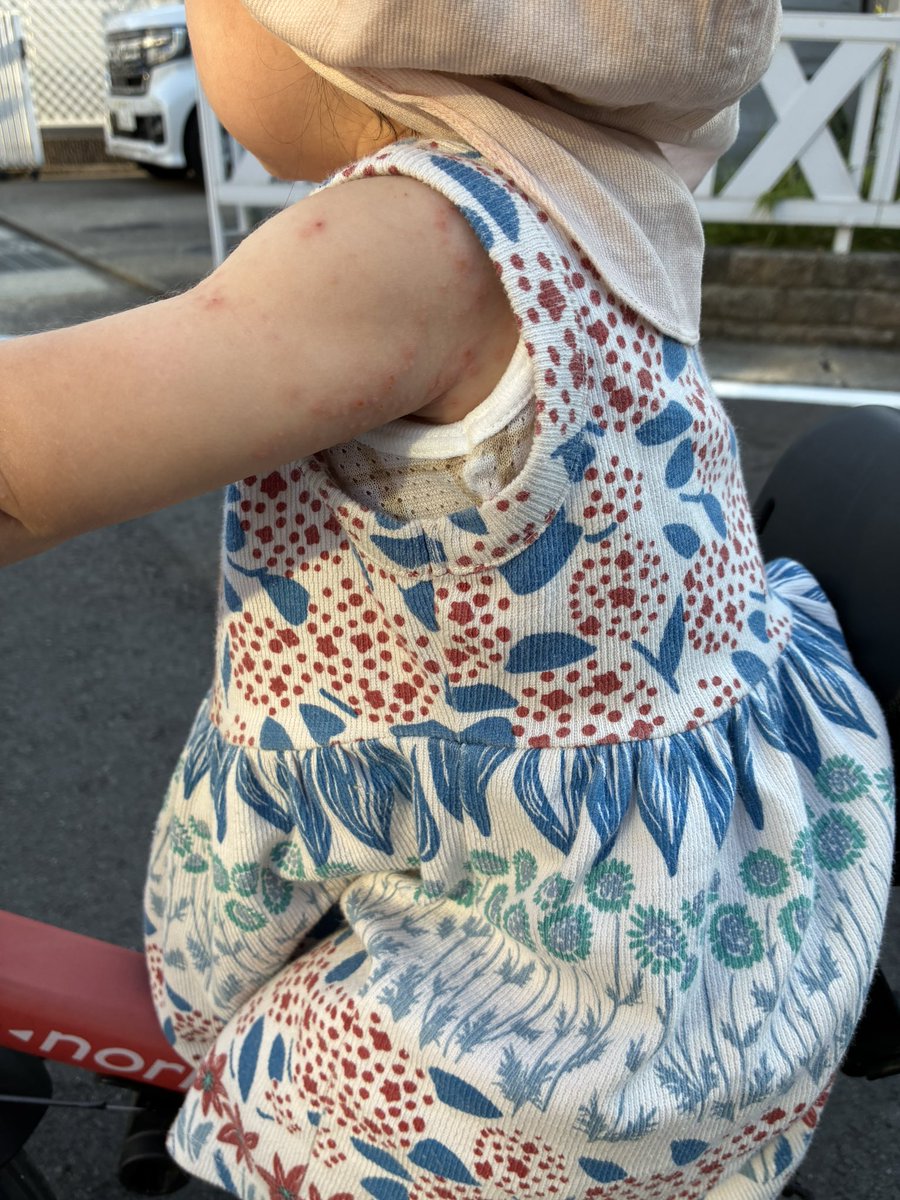 4m712boy's tweet photo. これは病院いってないけど手足口病だよねんってこと https://t.co/b41g9lc97s