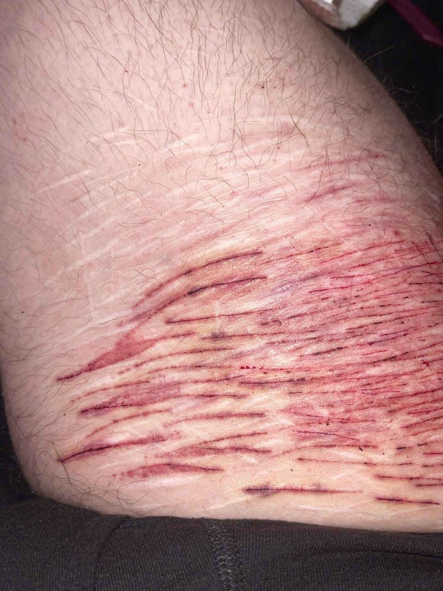 cannibalcats3's tweet photo. ignore how massive my thigh is. you can’t even see the ones i just did two min tires ago and it pisses me off!!! 
FAKE!! MAKE UP SFX STAGE MAKEUP!!!! NOT REAL!!! AI GENERATED!!!!! SPECIAL EFFECTS MAKE UP! https://t.co/9bMUh6hnwa