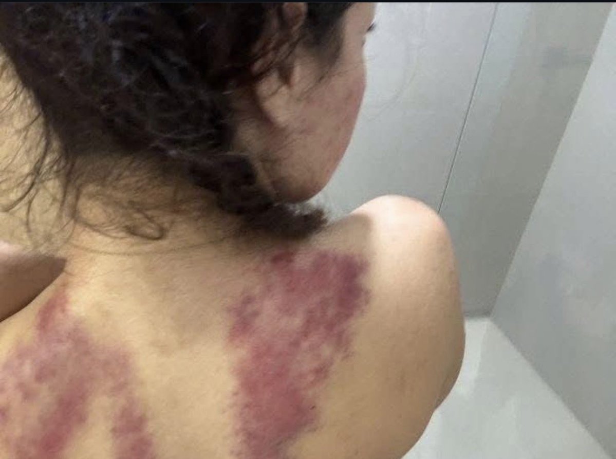 nbonbargasht's tweet photo. "My friend was arrested for chanting against the Islamic Republic in Iran, she is a single mother. To teach her a lesson, the regime forces group raped her in Prison. 

She had a spine surgery due to the assault and now She is having her uterus removed due to injuries. 👇🏽 https://t.co/8oSQO5bQkn