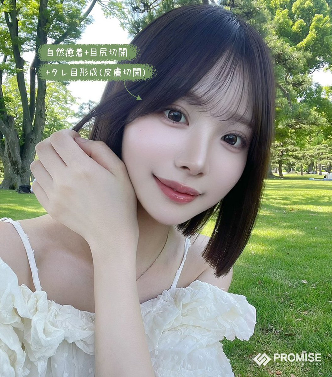 promiseplasty's tweet photo. 🧡二重(自然癒着)+目尻切開＋タレ目形成(皮膚切開)🧡
タレ目形成(皮膚切開)は皮膚を除去するのと同時にまぶたを骨膜に固定する方法で、下まぶたの２分の1(中央から目尻のカーブ)を下げる手術です。タレ目形成(結膜切開)と比べて下瞼全体的が下がったような効果がある手術です。

📍プロミス整形外科 https://t.co/yXvyZ1qG73