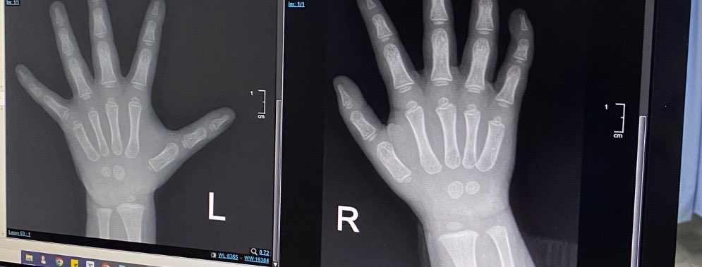 bardanslm's tweet photo. waktu umur 2 tahun-an anak kejepit pintu toilet sama saya, tentu saja istri sudah ngamuk, saya jg panik bawa ke RS. 

di RS ternyata pas di X-Ray wajib scan tangan kanan dan kiri buat perbandingan. 1 tangan 500K, 2 tangan 1 juta wkwk

demi anak saya gaeskeun aja dicek. 
setelah liat hasilnya jantung saya copot alias kok tulangnya gak nyambung??? saya kira karna kejepit pintu. 

respon dokternya tanya "anak pertama ya pak???" sambil ketawa2 

habis itu kami pulang anaknya udah ketawa2 lagi, dan baik2 saja ternyata 🥲