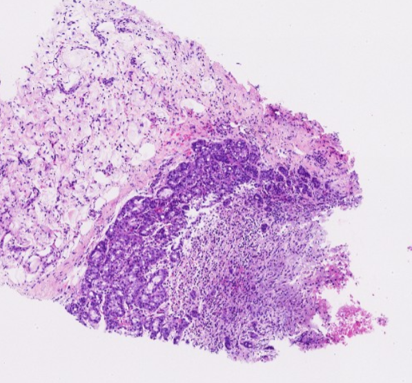 Janiranavarro's tweet photo. Unusual breast lesions
Infacted lactating adenoma
Dr. Cimino Mathews #BreastPath #USCAP #pathology #PathX #PathTwitter https://t.co/309mpLEIfh