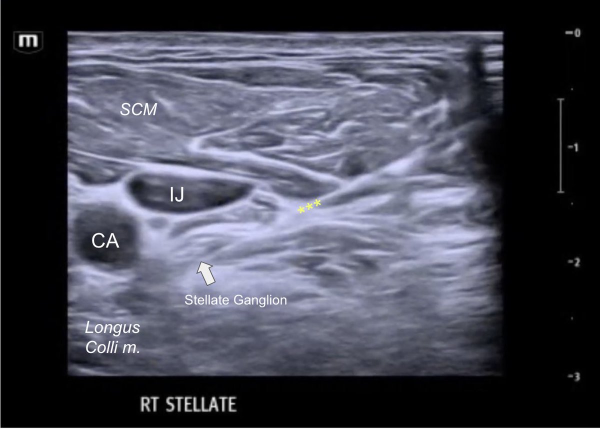 BrookdaleSono's tweet photo. Not every V-tach needs a shock. Sometimes just needs a #StellateGanglionBlock ⚡️

65 yo M with recurrent shocks from AICD in V-tach storm. 

#BrookdaleSono #ventriculartachycardia #nerveblock #EmergencMedicine https://t.co/5QIhyprD0d