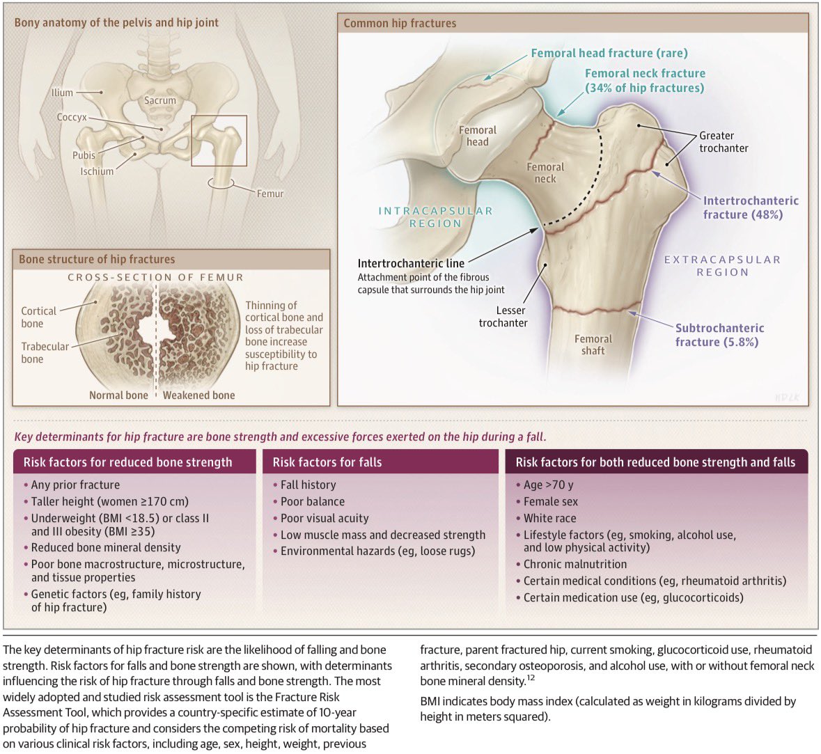AmbrizMau's tweet photo. Ilustración sobre las clasificaciones de las fracturas de cadera y sus factores de riesgo en adultos mayores:

JAMA 2026; DOI: 10.1001/jama.2026.11895 https://t.co/1qNwGTAnim
