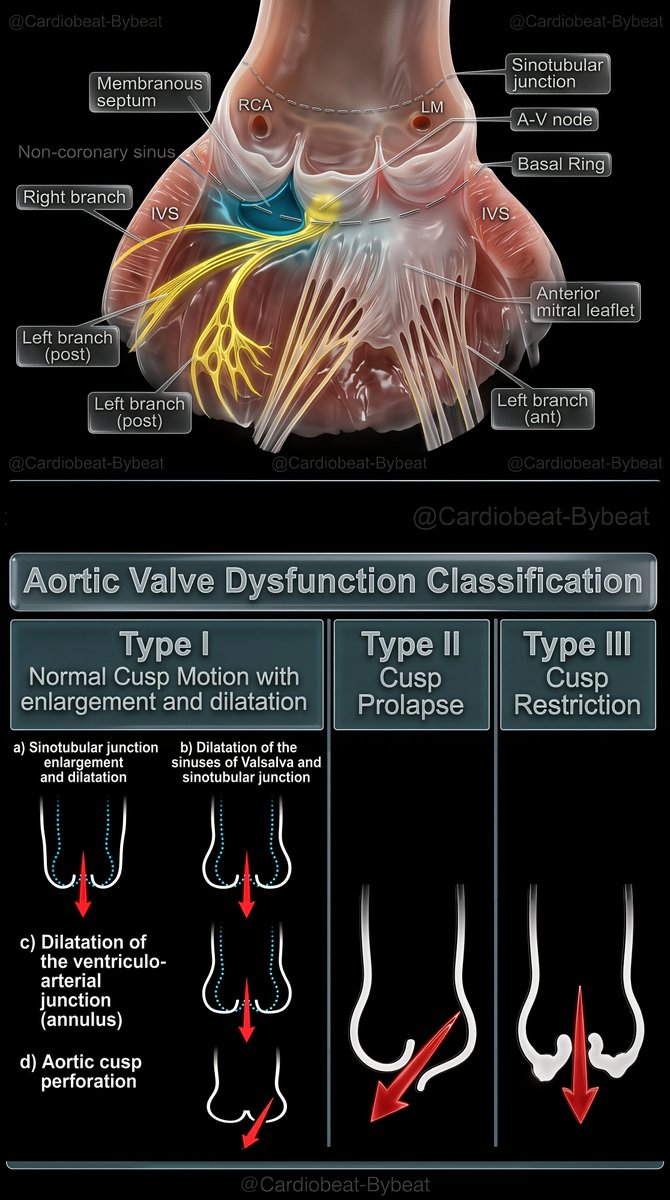CardioBeat_'s tweet photo. https://t.co/Xeh9opjZuC
🫀 Aortic Valve Dysfunction Classification
Type I – normal cusp motion with root/annulus dilation ± perforation; Type II – cusp prolapse; Type III – cusp restriction. 
Precise anatomy guides valve-sparing repair strategy. 🔬📚 #Cardiology #AorticValve https://t.co/dpsxfJB4kR