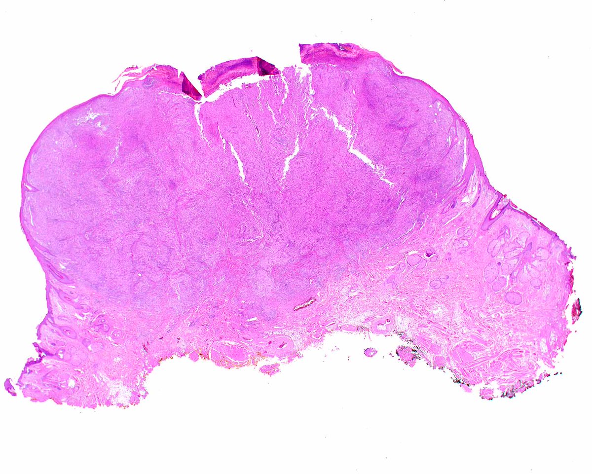 ModernPathology's tweet photo. Interdigitating reticulum cell sarcoma can be considered a malignant variant of Rosai-Dorfman disease! S100 protein was + (not shown).
Ravindran A,  et al . Mod Pathol. 2023 Oct;36(10):100268. PMID: 37406859. https://t.co/d6wVExjA3K