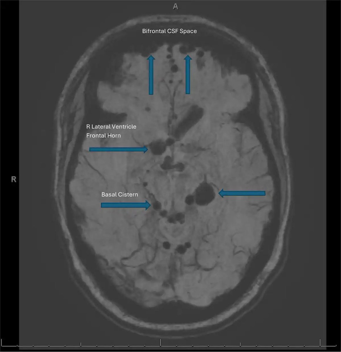 _Anesthesiology's tweet photo. Images in #Anesthesiology - Air Entrainment and Subsequent Pneumocephalus Associated with Epidural Blood Patch 📷 https://t.co/hUYKes0EDs https://t.co/iOCEL0poZz