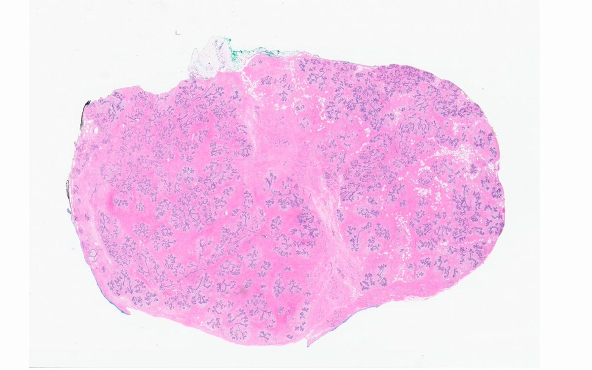 fouad_boulos's tweet photo. 40-year-old woman with a breast mass.
What is your diagnosis?
#breastpath #pathX #PathTwitter https://t.co/rWEeavrDEt