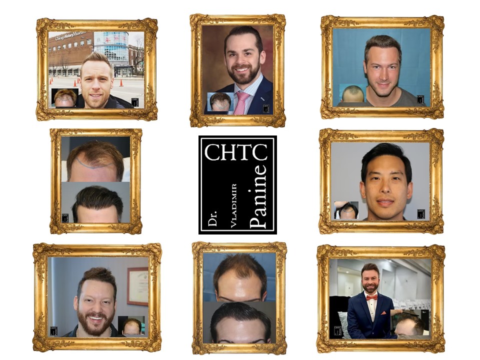 DrPanine's tweet photo. 🌟 Real Transformations. Real Confidence. 📷Another powerful set of results from the Chicago Hair Transplant Center with Dr. Vladimir Panine.

From thinning hairlines and visible bald spots to thick, natural-looking hair — these patients are proof that the right technique, artistry, and experience make all the difference.

Every frame tells a story of renewed confidence and a fresh start.

Thank you to our amazing patients for trusting us with their journeys!

Thinking about your own hair restoration?
Schedule a no-obligation, private consultation today.

@DrPanine 

https://t.co/5q8K5aptjW

(312) 888-2385

#ChicagoHairTransplant #DrVladimirPanine #CHTC #HairTransplantResults #BeforeAndAfter #HairRestoration #MensHairTransformation #NaturalResults #HairTransplantChicago