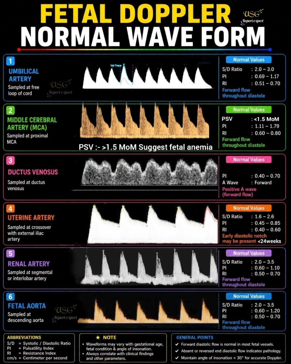 mznljrdy47597's tweet photo. Fetal Doppler Normal Waveform Ultrasound 

#Ultrasound #dopplerultrasound #doppler #pregnancy #pregnant https://t.co/0x08Wf9VHS