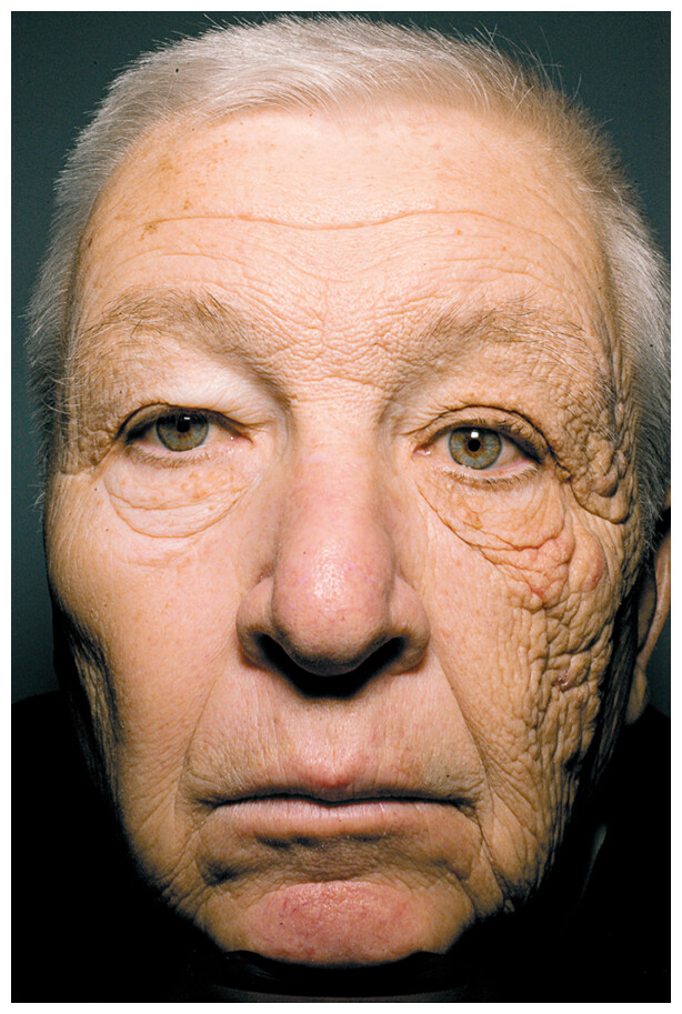 darkmodebio's tweet photo. This truck driver had UV radiation exposure to one side of his face for 25 years, resulting in one side of his face aging more rapidly. You can absolutely increase your expected lifespan by changing behavior.

https://t.co/aUOk4W2Wo0 https://t.co/B8q3yBaCw9