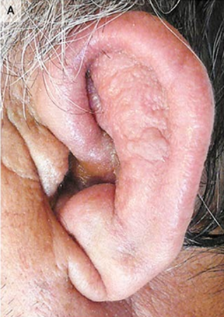 guerreroespejo's tweet photo. A 63-y-o ♂️ with recurrent aseptic #meningitis: fever, headache, scleral injection & nuchal rigidity
CSF: monocytic pleocytosis indicative of aseptic meningitis
Marked bilateral auricular swelling & redness developed (A)
1/2
DOI: 10.1056/NEJMicm0901800
#Neurology #IDX #emergency https://t.co/GSFXDanZ6y