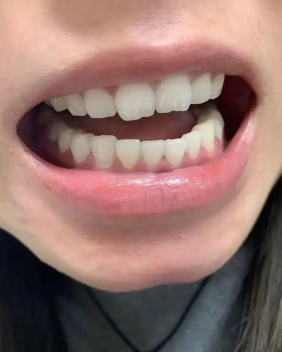 faradistyy's tweet photo. SUNGKEM SAMA DENTIST GUE 🙏🏻😭 Pas kontrol malah dipuji, katanya gigi gue sekarang lebih putih dan karang giginya jarang banget muncul.

Padahal beliau sendiri yang dulu nyuruh gue ganti ke pasta gigi yang ada kandungan hydroxyapatite 😭🤣 ternyata emang ngaruh donggg￼ https://t.co/Ih57wZUoL9
