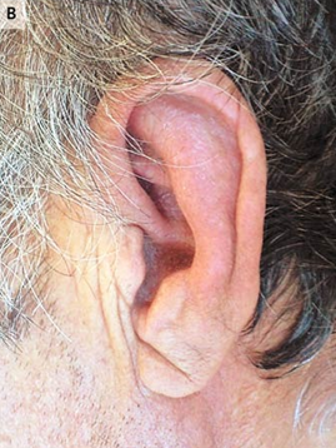 guerreroespejo's tweet photo. Auricular biopsy: inflammatory changes, seen in RELAPSING POLYCHONDRITIS
➖a inflammation of cartilage, in rare cases, the meninges can be affected
Corticosteroid: improved the meningeal symptoms & the auricular swelling (B) within a few days
2/2
#medicine #IDMedEd #microbiology https://t.co/ftzjqIVclW