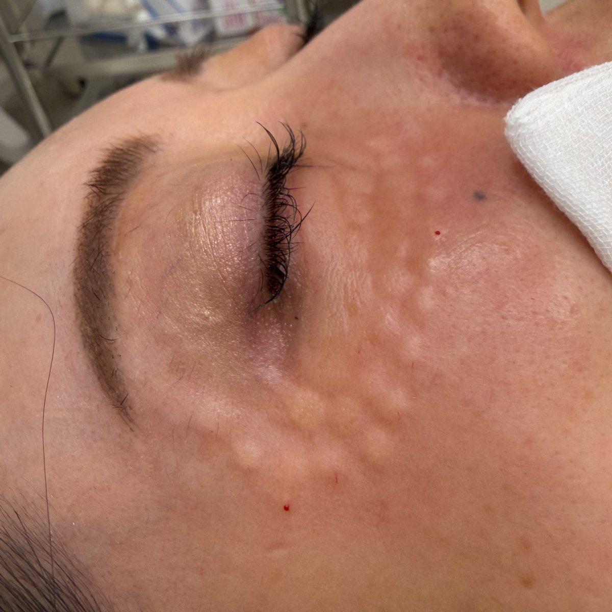 skinfinity_ht's tweet photo. 目元の小じわ対策には私はスネコスやウルトラコルを症状に合わせて使い分けます

スネコスがあまり効かないのですが？

とセミナーなどで講演するとよく頂く質問ですが、スネコスは的確な層に充分量を注射するのが大切

写真は注射直後の状態ですが、片側目の下に1から1.5ccほど私が手打ちで注入します https://t.co/KXTTP2E2qM
