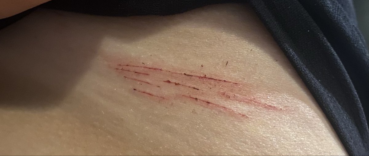 svvann10's tweet photo. Cat scratches on my hip because I’m going swimming tomorrow 😓 https://t.co/x0pp3yuUZt
