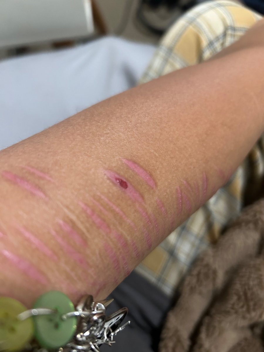 aceofblvdes's tweet photo. whats up with this scar why did it randomly grow a small red spot https://t.co/TyLlrp2854