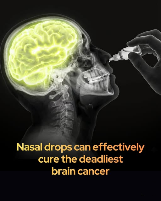 Rainmaker1973's tweet photo. A simple nasal drop may defeat one of the most aggressive brain cancers.

Glioblastoma remains one of the most aggressive and lethal forms of brain cancer, with a five-year survival rate of just 6.9%. Yet a promising new treatment strategy is raising hopes for dramatically better outcomes.

An international team from Washington University in St. Louis and the University of Electro-Communications in Japan has pioneered a noninvasive way to deliver immunotherapy directly to the brain—using simple nasal drops.

The difficulty in treating glioblastoma has always been the blood-brain barrier and the tumor’s ability to suppress immune attack. Past efforts to stimulate the immune system with STING agonists either required invasive brain surgery or failed because the drugs degraded too quickly.

The researchers solved both problems by re-engineering STING-activating molecules into “spherical nucleic acids” clustered around tiny gold nanoparticles. This structure protects the drug, allows it to travel through the nose-to-brain pathway, and keeps it active much longer.

When administered as nasal drops in mice with glioblastoma, the treatment successfully triggered powerful anti-tumor immune responses and significantly slowed tumor growth.

Beyond glioblastoma, this platform could potentially help treat other cancers that resist immunotherapy. Although human trials are still years away, combining these nasal drops with existing checkpoint inhibitors might one day produce lasting immunity against the disease.

This elegant, patient-friendly approach represents a major advance in overcoming the brain’s natural defenses—bringing renewed optimism to a field where truly effective treatments have remained elusive for decades.

["cGAS-agonistic spherical nucleic acids reprogram the glioblastoma immune microenvironment and promote antitumor immunity." PNAS, 2025]