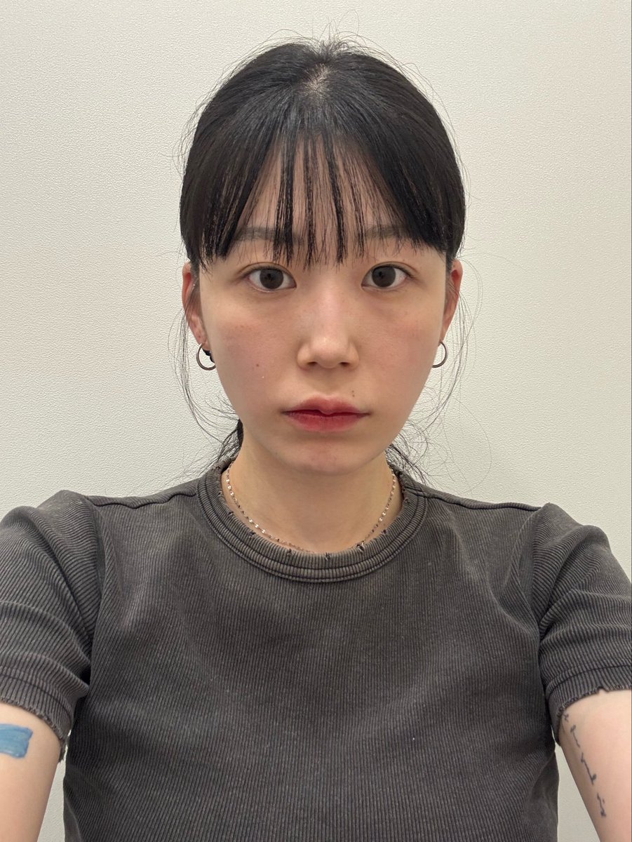 l___8___l's tweet photo. ディオンクリニックで・ホクロ除去・リボンコラーゲン2cc・ウルセラ300shot
してもらいました🎀カウンセリングから丁寧で、満足です◎施術をしながらおすすめもしてくれるので興味があり+してもらいました✨(リボンコラーゲン+1cc)
#新沙ディオンクリニック #韓国クリニック #韓国美容皮膚科 #肌管理 https://t.co/GhF1rxNdFd