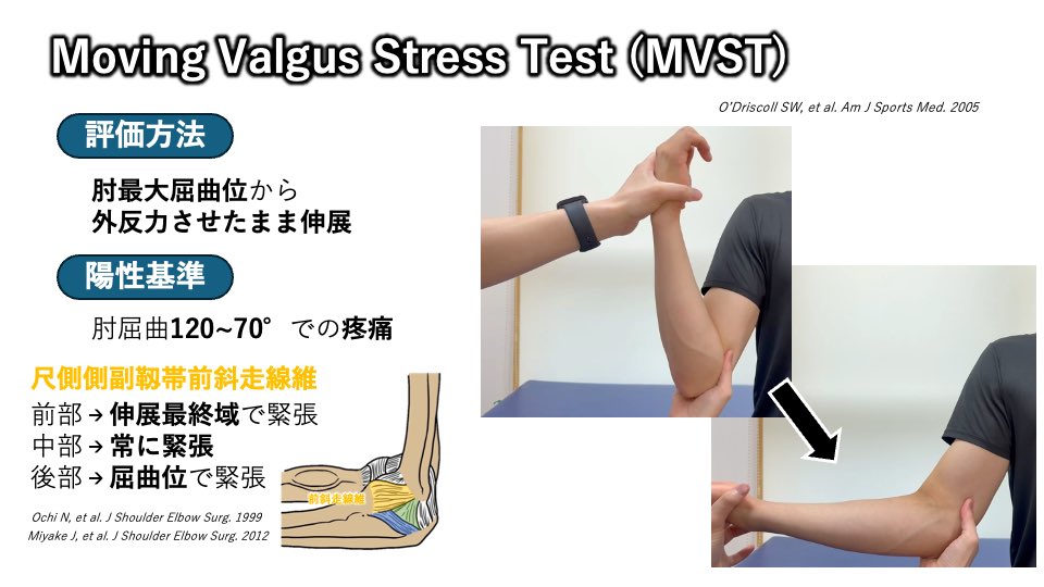 tsui_pt's tweet photo. ⚾️ Moving Valgus Stress Test（MVST）は「70〜120°」だけ見ればいい？

MVSTは野球選手の内側肘痛評価で広く用いられるテストです。

O’Driscollら（2005）は、
肘屈曲120〜70°での疼痛を陽性基準として報告し、高い感度・特異度を示しました。

しかし、解剖学的な視点を加えると少し見方が変わります。

尺側側副靱帯前斜走線維（AOL）は部位ごとに緊張パターンが異なり、

🔹前部線維：伸展最終域で緊張
🔹中部線維：全可動域で緊張
🔹後部線維：屈曲位で緊張

とされています。

そのため、

✅ 70〜120°で痛みが出るか
✅ 最終伸展まで症状が増悪しないか

の両方を確認することで、より詳細に病態を推測できる可能性があります。

特に投球障害肘では、

「70〜120°では痛くないけど、最後まで伸ばすと痛い」

というケースも経験します。

MVSTは単なる陽性・陰性ではなく、

“どの角度で症状が出現し、どの角度で増悪するのか”

まで観察すると評価の質が変わるかもしれません💡