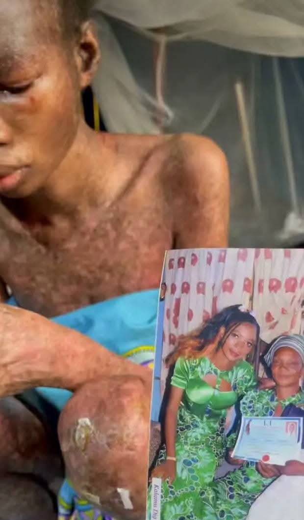 kenkenlewu's tweet photo. The lady in the green dress is the SAME person you’re seeing in the other slides. 💔

Her name is Omowunmi, and she’s only 25 years old.

She got pregnant, and a few months into her pregnancy, a large dark mark suddenly appeared on her back.

At first, everyone thought it was just pregnancy-induced eczema, so it wasn't taken too seriously.

But instead of disappearing, it kept getting WORSE.

Even after she gave birth, her condition continued to deteriorate until she had to be rushed back to the hospital for proper medical attention.

After several tests, Omowunmi was diagnosed with LUPUS — an autoimmune disease in which the immune system mistakenly attacks the body's own tissues.

Sadly, tragedy struck again. 💔

Omowunmi lost her baby at just 1 month and 10 days old.

According to her account, the baby's death was linked to complications associated with lupus.

May the little baby's soul rest in peace. 🕊️

Unfortunately, lupus currently has no cure, but with proper treatment and medical management, its symptoms and complications can often be controlled.

The disease can affect different parts of the body, including the skin, joints, kidneys, heart, lungs and other organs.

“What do women bring to the table?”

Yeah, one is THIS! Because of pregnancy!