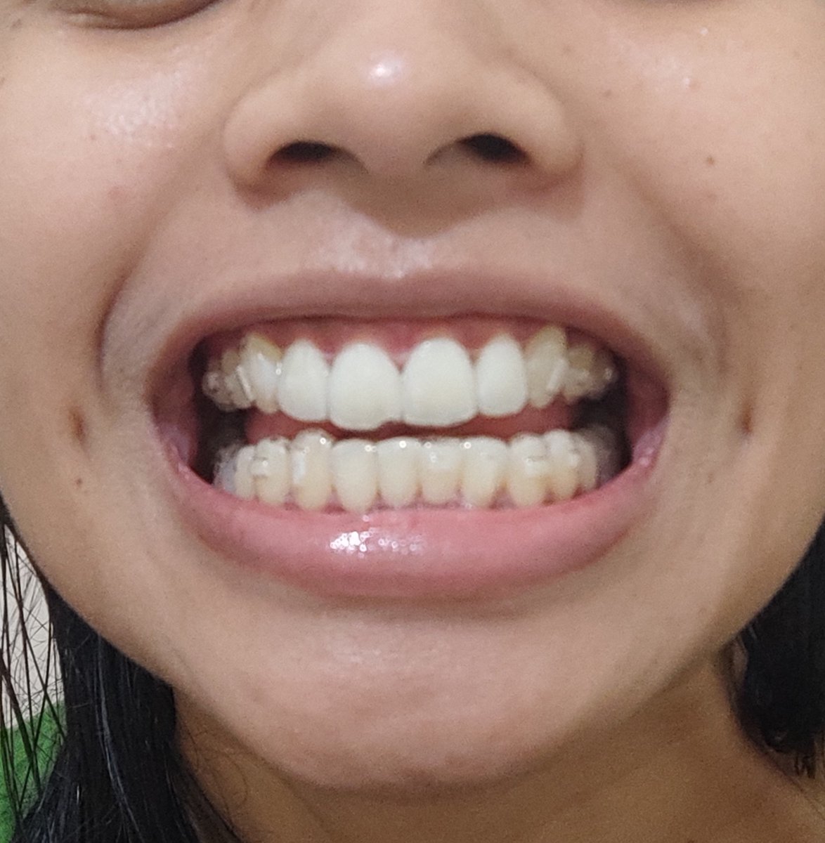 waungwuff's tweet photo. Barusan ini tadi ganti ke set 8 dari 17 set di plan-nya 

Tinggal hilangin jarak hitam-hitam antar giginya, yg kalo pake aligner juga udah nggak keliatan

Sama nyatuin gigi atas bawah belum ketemu penuh https://t.co/qk626rQf7t