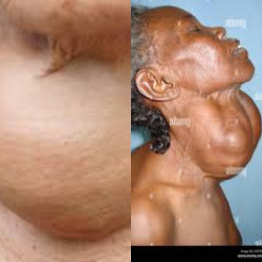 Maryam_care's tweet photo. 🦋 What is Goiter?

Goiter is an enlargement of the thyroid gland, causing swelling at the front of the neck.

Common causes include: 🧂 Iodine deficiency 🛡️ Autoimmune thyroid diseases 🧬 Some inherited conditions

If you notice a swelling in your neck or have difficulty swallowing or breathing, see a healthcare professional for evaluation.

Follow @Maryam_care for trusted health education.

#Goiter #Thyroid #HealthEducation #DrMaryamCare
