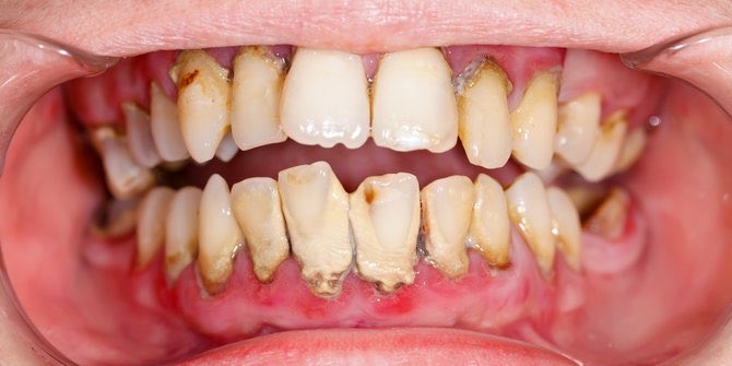 sabbb04's tweet photo. 🦷 DICARI PASIEN DENGAN KARANG GIGI 🦷

Apakah Anda atau keluarga memiliki keluhan seperti:
✅ Karang gigi menumpuk dan tebal
✅ Gusi sering berdarah saat menyikat gigi

📢 Saya sedang mencari pasien untuk perawatan pembersihan karang gigi (scaling) di area Semarang.

✨ Perawatan dilakukan oleh mahasiswa profesi Kedokteran Gigi di bawah bimbingan dokter gigi spesialis

📍 Jika Anda memiliki kondisi seperti pada foto atau mengenal seseorang dengan keluhan tersebut, silakan hubungi saya melalui chat.

🙏 Mohon bantuannya untuk membagikan informasi ini. Terima kasih.
#semarang #koassemarang #scallingigi  #pasienkoas #karanggigi #koasgigi #doktergigimuda