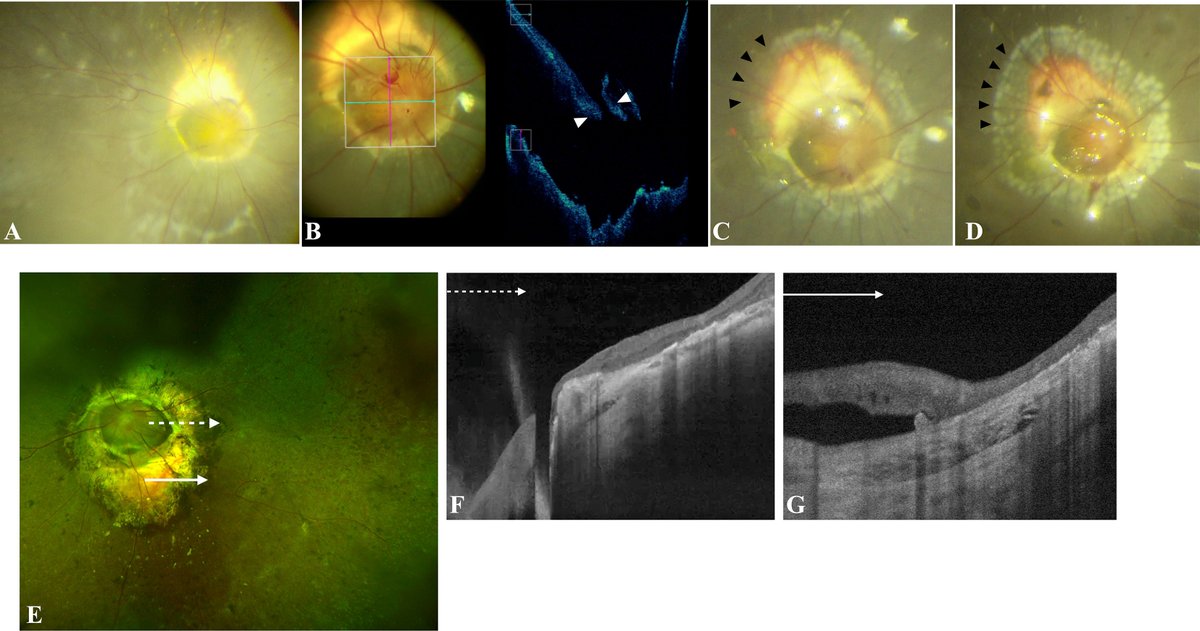 AAOjournal's tweet photo. Surgical Outcomes and Prognostic Factors in Morning Glory Syndrome–Associated Retinal Detachment
https://t.co/ZPg68m0yhA
#ophthalmology #retina https://t.co/7dtif0s7PK