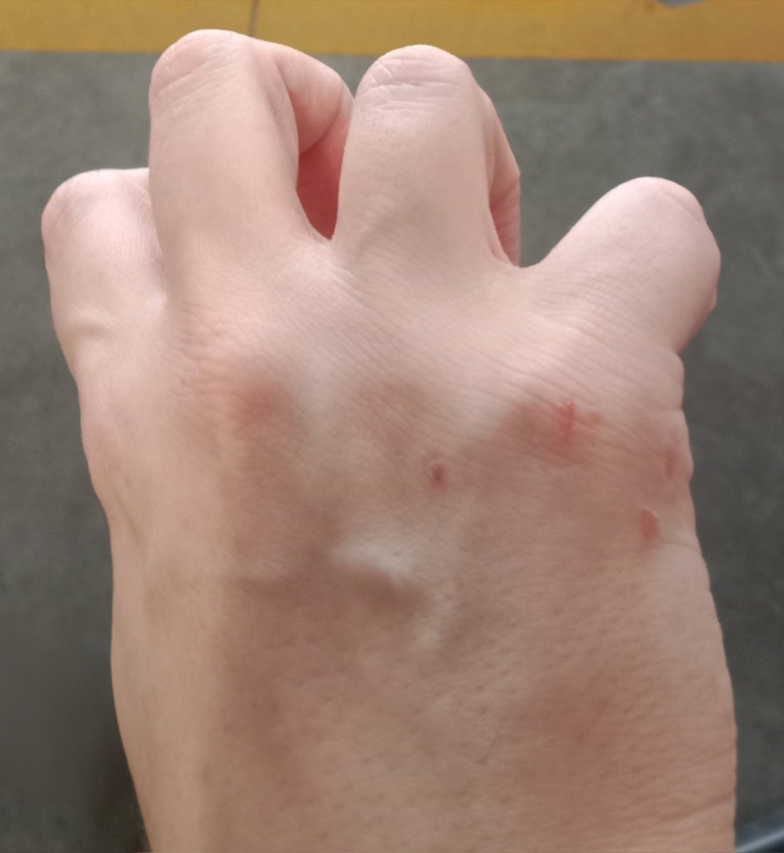 ContessaMBGatta's tweet photo. Dare un pugno su una cosa, perché ultimamente sono parecchio sotto stress, e ridursi una mano così... L'oggetto a cui ho tirato un gancio non si è fatto nulla, si è solo sporcato un poco del mio sangue, io mi sono procurata per la botta -autoinflitta, per l'impatto tra soggetto inanimato e mie stesse ossa, senza volerlo di proposito- queste ferite... 
Tirare pugni non fa decisamente per me...
Contessa Muci Borgia
