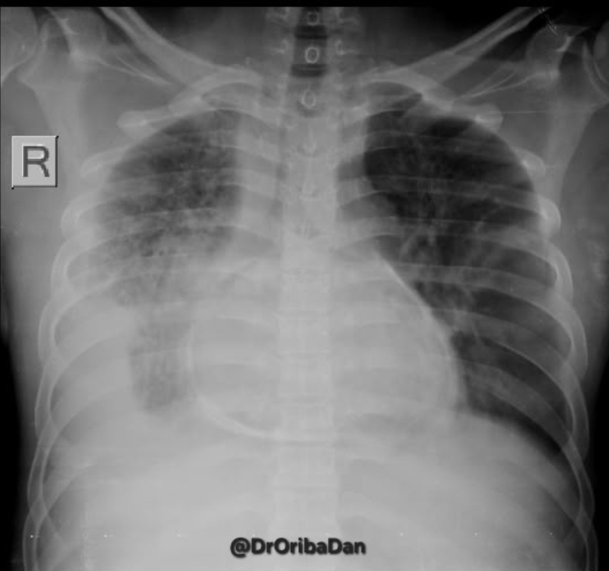 DrOribaDan's tweet photo. A 38y/M, HIV+, with history of pulmonary TB Rx. 12 yrs ago, C/o acute chest pain & DIB
✍️BP 78/48mmHg, PR 148bpm, SP02 98% on Oxygen. Absent Heart sounds.
Has multiple violaceous macules on the skin.
Thoracentesis= Hemorrhagic Effusion
✍️What is your Dx & CXR findings? https://t.co/NgD5M8cGuD