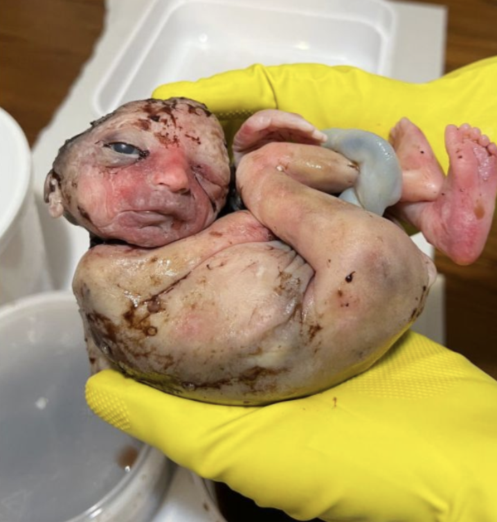 LiveAction's tweet photo. This is LONG overdue.

Baby Harriet was one of the DC Five.

In 2022, she was found in a medical waste bin with an incision on the back of her neck indicating she may have been killed by the FEDERALLY BANNED partial-birth abortion procedure.

Until now there has been no investigation into the potential crimes committed against these babies.

We MUST demand #JusticeForTheFive.
