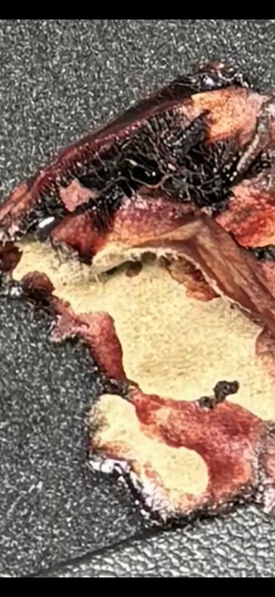 Sunny61120's tweet photo. This is burnt flesh with the  shirt melted onto the flesh. Notice the distinct skin pattern in the blackened area? That puffing out happens with severe skin burns when the flesh is literally cooked (not to be gross) but it pops the butter layer of skin out like a porkrind. Fuethermore, notice how the one area flopped over looks leathery on the inner side but the outter side is white. That is again cooked flesh on the underside of the shirt that melted to his skin (or whatever material was under his shirt on his skin) there is also a shiny piece of metal in the most charred area and more of that glass, but with visibility blood on it placing it jn direct contact with Charlies body (UNLESS) the people in the car had bloody hands and were grabbing this glass off of Charlie and tossing it in the backseat. @RealCandaceO @baroncoleman @GraceSm16250397