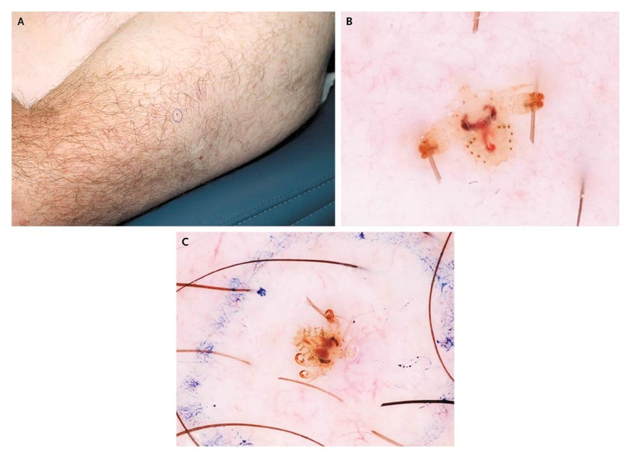 guerreroespejo's tweet photo. A 50-YO♂️: a 1-month history of generalized pruritus, yellowish-brown flecks in the hair of the upper arm (A), chest, and axilla on the left side and in the pubic area.
Dermoscopy (B,C): !?
1/2
DOI: 10.1056/NEJMicm0810134
#Parasitology #dermatology #MedEd #IDMedEd #microbiology https://t.co/lmLGWkuxX9