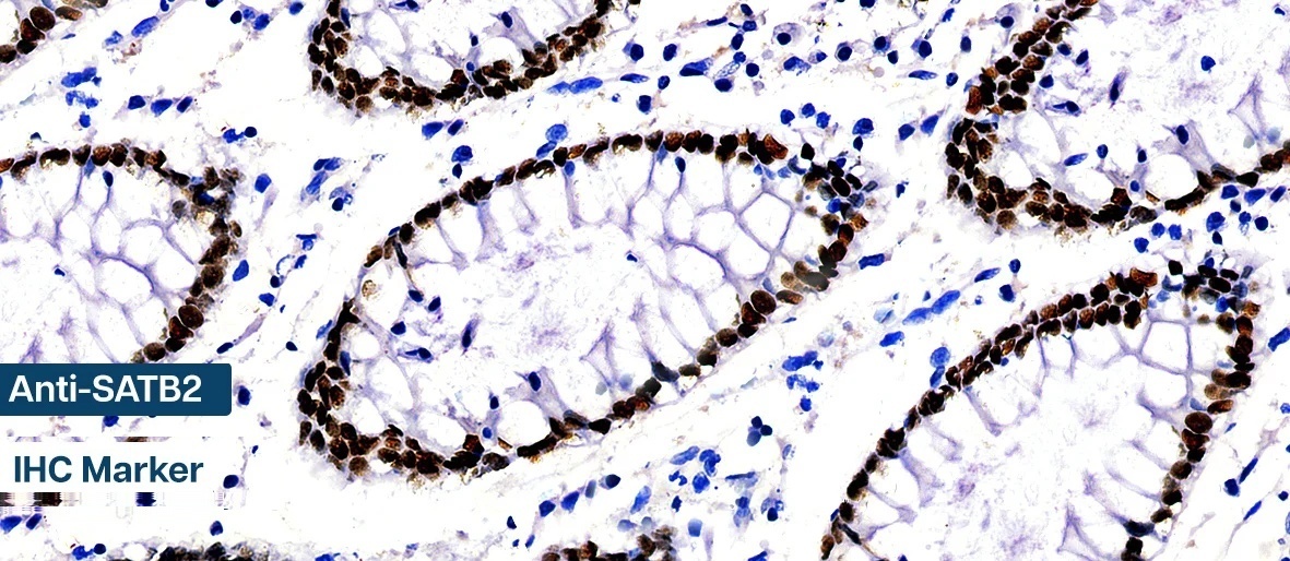 biogenexlabs's tweet photo. 🔬 Advance diagnosis with BioGenex SATB2 IHC Marker—reliable nuclear staining for Hodgkin’s lymphoma, lymphoblastic leukemia &amp; colorectal adenocarcinomas.

✓ High sensitivity &amp; specificity
✓ RTU &amp; Concentrated formats

🔗 https://t.co/p1vp7wa819

#SATB2 #IHC #Pathology #Cancer https://t.co/JKGrW42hwJ