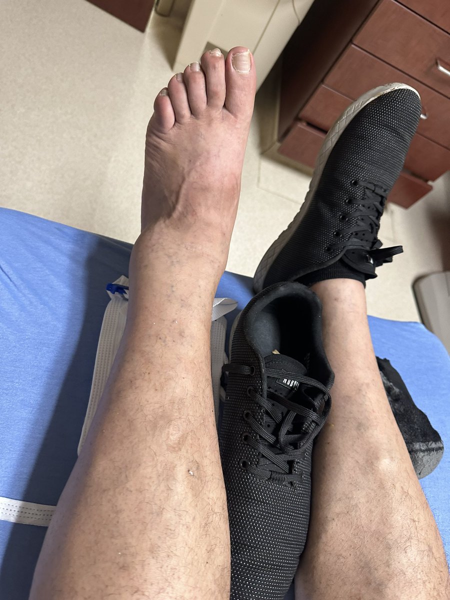 Evilgh05t's tweet photo. Life can change in an instant.
One moment you’re going about your normal routine, and the next you’re facing challenges you never expected. After a fall, I ended up with a broken ankle that may require surgery. During the scans, doctors also discovered a fat-containing lytic lesion in the neck of the left proximal femur, which now requires further evaluation and a biopsy to determine what it is.
It’s a reminder that we should never take a single day for granted. Enjoy the moments you have, appreciate the people around you, and make the most of every opportunity — because life can bring unexpected turns when you least expect them.
Life is full of unfortunate surprises, but it’s also full of strength, hope, and the ability to overcome.
Thank you to everyone who has reached out, shown support, and stood by me during this journey. It truly means more than you know. ❤️
#StayStrong #OneDayAtATime