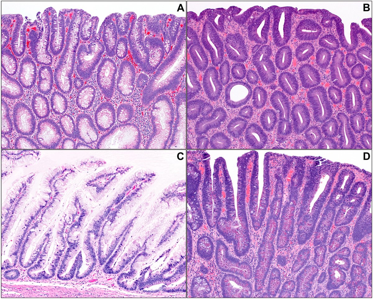 Human_Pathology's tweet photo. New in #HumPathol: Nonconventional Colorectal Dysplasia Is Less Prevalent and Has a More Limited Morphologic Spectrum in Patients Without Inflammatory Bowel Disease. https://t.co/gxSTIgFURG #pathology #PathTwitter #PathX #gipath https://t.co/TYi7TqLLD0