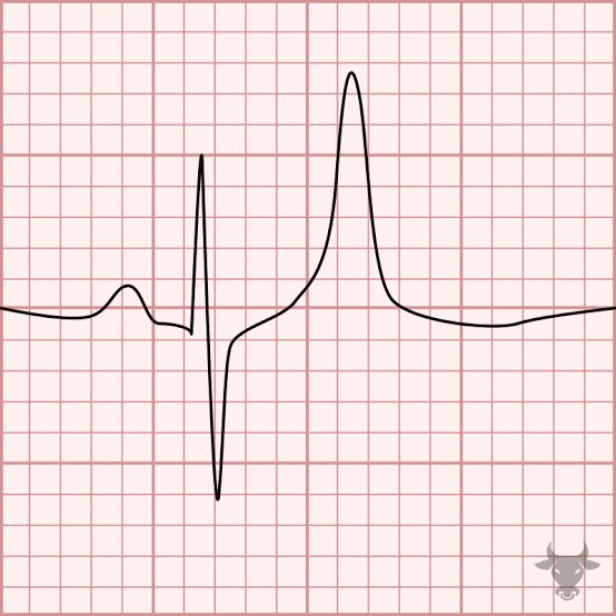 Medzonetv's tweet photo. Dialysis patient misses session.

Peaked T waves.

What do you give first? https://t.co/tgr7iRsKOq