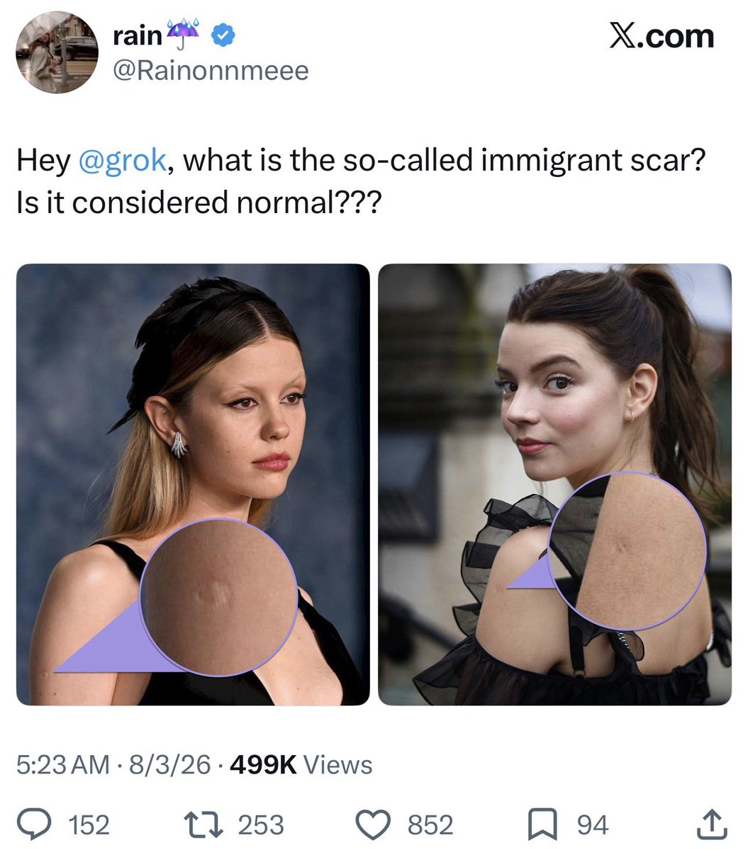 caiziboshi's tweet photo. 美国社交媒体上常把手臂上的卡介苗（BCG）接种疤痕戏称为 “immigrant mark（移民印记）” 或 “immigrant scar（移民疤）”，因为美国几乎不对儿童常规接种BCG，而来自中国、日本、韩国、印度以及许多亚洲、非洲、拉丁美洲国家的移民，大多在婴幼儿时期接种过，因此左上臂外侧（三角肌附近）常留有一个直径约5–10毫米的圆形疤痕。欧洲并非所有国家都接种BCG，东欧及部分结核病发病率较高的国家长期实行常规接种，而英国、德国、法国、荷兰等许多西欧国家已取消全民接种，改为仅针对高风险儿童。美国之所以不普遍接种BCG，是因为结核病发病率长期较低，主要依靠筛查、隔离和治疗控制疫情，同时BCG对成年人肺结核保护效果有限，还可能影响传统结核皮试结果。美国儿童虽然也会接种DTaP、MMR、水痘、流感、HPV等多种疫苗，但这些通常注射在婴儿大腿前外侧或较大儿童的上臂三角肌，属于肌肉或皮下注射，一般不会留下明显疤痕。因此，在美国看到典型的BCG圆形疤痕，更容易让人联想到在国外出生或成长的人，这也是“immigrant mark”这一网络俗称的由来，但它并非医学术语，也不能据此判断一个人的国籍或移民身份。