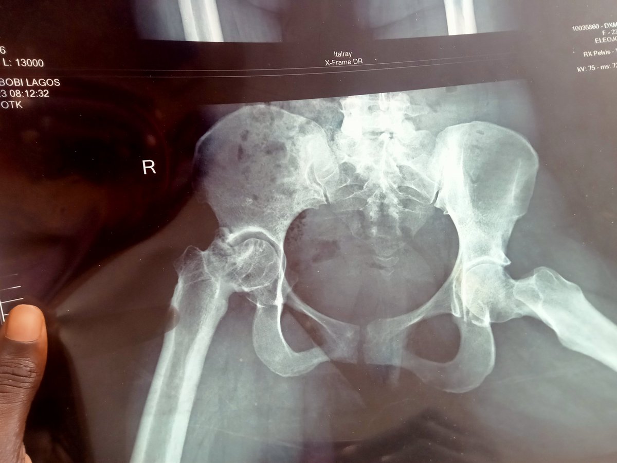 giftcurator's tweet photo. I don't usually ask for help publicly, but today I have no choice.

I'm trying to raise funds for a Total Hip Replacement surgery that will give me a chance to live without constant pain.

This is my story.

When I was 9 years old, I was involved in an accident that left me with a pelvic fracture. I was admitted to the hospital and underwent treatment. Eventually, I was discharged, and for a while, life seemed normal again. About two years later, I started limping; something wasn't right. We thought to seek help at another hospital, hoping to find answers. Unfortunately, I was placed on the wrong treatment. It nearly cost me my leg but left me with one leg shorter than the other.
Eventually, I was referred to an orthopaedic hospital and after proper evaluation, doctors discovered that the ball of my hip had come completely out of the pelvic socket.
I underwent surgery called in-situ pinning to put it back in place. Some time later, I had another surgery to remove the screw.
Even after those surgeries, I never completely stopped feeling pain. I simply learned to live with it. I adjusted my life around the discomfort because I thought that was just how things would always be.
But over the years, the pain became worse; what I could once ignore has now become unbearable.
Walking, standing for long periods, climbing stairs, sleeping comfortably, and even carrying out everyday tasks have become incredibly difficult.

I recently went for another evaluation and had an X-ray done. The result was heartbreaking. The hip joint has deteriorated badly, and the doctors have recommended a Total Hip Replacement as the best and most lasting solution.

The cost of the surgery, implants, and hospital care is ₦3,369,498.99 million.
By God's grace and through the kindness of family and a few generous people, I've been able to raise ₦1.6 million and I'm deeply grateful.

However, I still need approximately ₦1.6 million to make this surgery possible. This isn't just about relieving pain, it's about getting my life back. It's about being able to walk with dignity, work, and live without every step reminding me of this injury.

If you're able to support me financially, no matter how small the amount, it will bring me one step closer to this surgery.
If you can't, please help me by reposting this thread. It could reach someone who can help.

Every share matters.

I will attach my medical bill and X-ray to this thread as transparency is very important to me.

Thank you for taking the time to read my story. Thank you for your prayers, your kindness, your support, and every repost. I truly believe that with your help, I'll be able to have this surgery and finally begin living free from this pain.

Donation details:
Ammeh Eleojo O.
GTBank
0165090231

Please repost. Thank you.