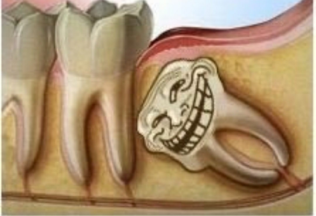 hydsbruck's tweet photo. J'ai pas de carte vitale et mes dents de sagesse décident de me troll en haut et en bas je vais mourir ou pas vous pensez si je les ghost ?? https://t.co/jgUwdcdKdW