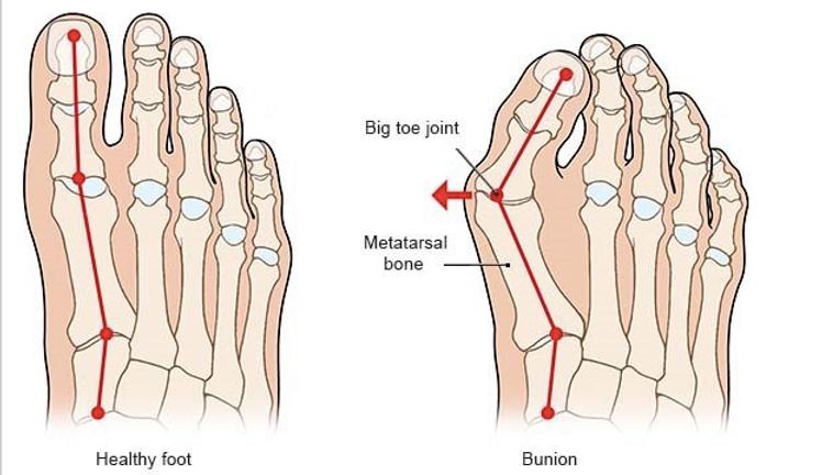 DrAngela4Health's tweet photo. What are BUNIONS and how to prevent them (a🧵):
NOTE: they are NOT genetic, but may be due to shared harmful lifestyle habits.