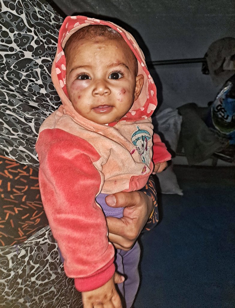 mahmoud60013's tweet photo. I beg you . The skin disease has spread, covering larger portions of her small body, reaching her face and eyes. Her eyes are swollen and red, and every tear she sheds only increases her pain and distress. The burning sensation is constant, and the intense itching prevents her from sleeping or finding any comfort. Doctors have confirmed that her condition requires urgent treatment. 
https://t.co/Q1uKW9Bwij
Please help us, even with a prayer in the Comments. Even if the comment is a dot