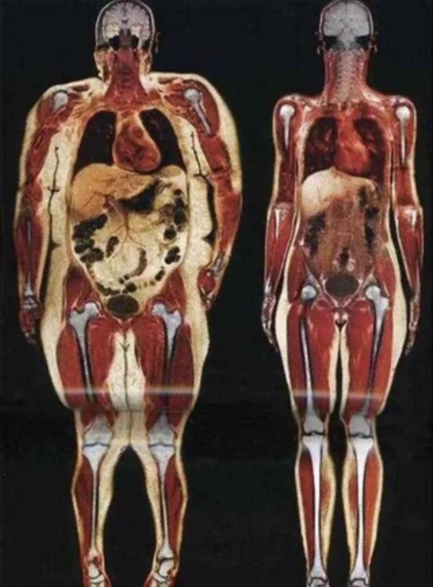 FrancescaBeanz's tweet photo. ur faily #fatspo !!! bodyscan of a woman who's 250lbs/113kg VS a bodyscan of a woman who's 125lbs/56kg!!! #edrtwt  #editwt https://t.co/4r7YA6eyam