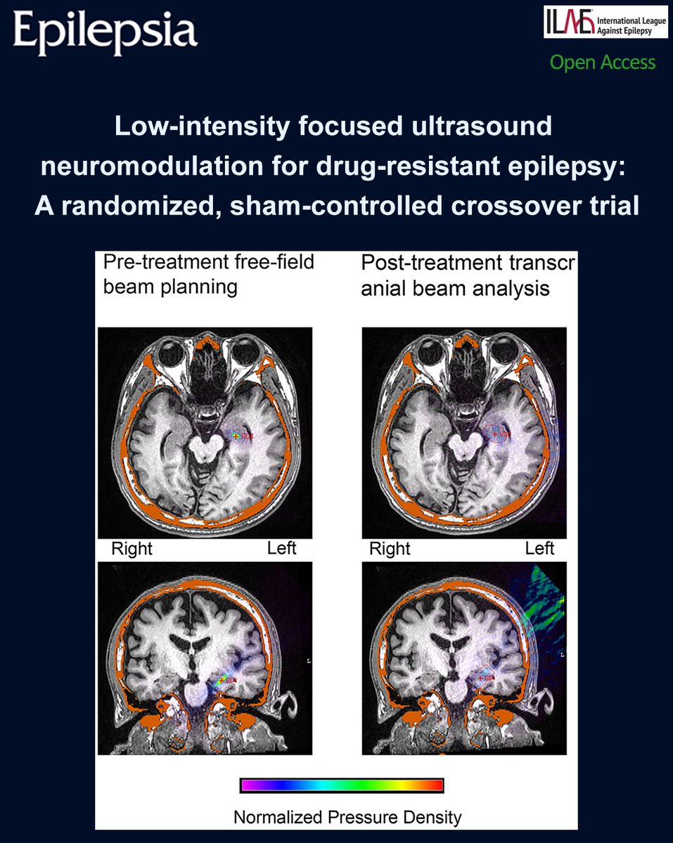 EpilepsiaJourn's tweet photo. The first sham-controlled crossover trial of LIFU in drug-resistant epilepsy was conducted.
https://t.co/DEq080rNMk
#epilepsy #ilae #epilepsia #crossovertrial #focusedultrasound #neuromodulation #noninvasive #brainstimulation https://t.co/f2sgLYHNd3