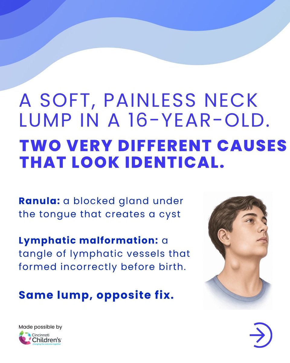 StayCurrentMD's tweet photo. A false positive salivary enzyme test led to two failed excisions. Never a ranula — a lymphatic malformation. 2025 Pediatric Surgery Update Course.

Full EP: https://t.co/YLjoFhy6jF

Register 2026: https://t.co/yuAQxw35JA

#SoMe4PedSurg #PedSurg

Made possible by @CincyChildrens https://t.co/9HfrCuaphS