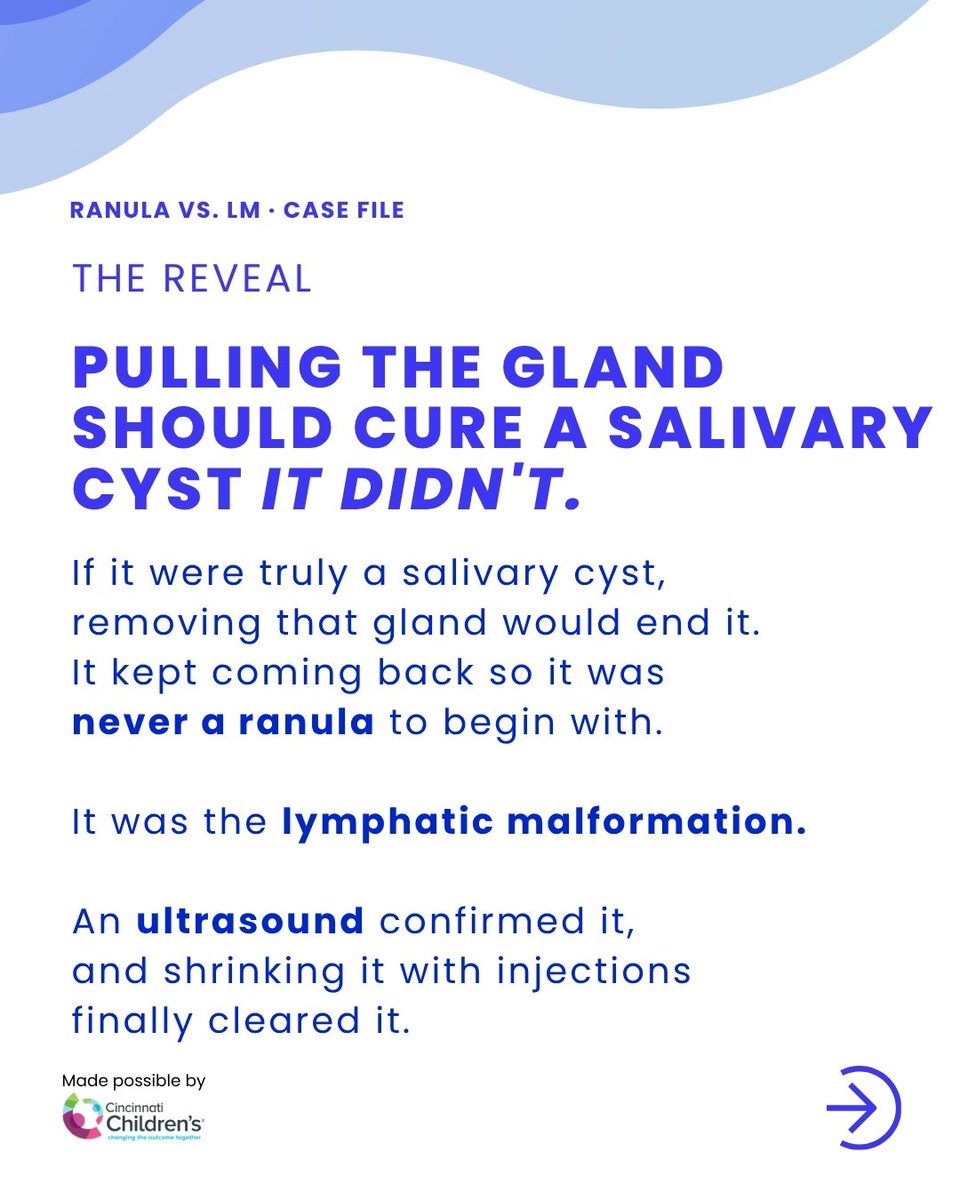 StayCurrentMD's tweet photo. A false positive salivary enzyme test led to two failed excisions. Never a ranula — a lymphatic malformation. 2025 Pediatric Surgery Update Course.

Full EP: https://t.co/YLjoFhy6jF

Register 2026: https://t.co/yuAQxw35JA

#SoMe4PedSurg #PedSurg

Made possible by @CincyChildrens https://t.co/9HfrCuaphS