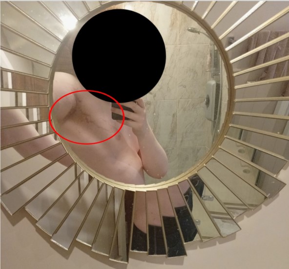 Shenmoooooo's tweet photo. I apologise for the awful quality, attrocious covering of my face, and weird ass mirror (I am the only person in my home without a mirror in my room, so I had to use the weird ass bathroom mirror) but these weird fucking stretch marks appeared overnight https://t.co/PiWbIXpPUt
