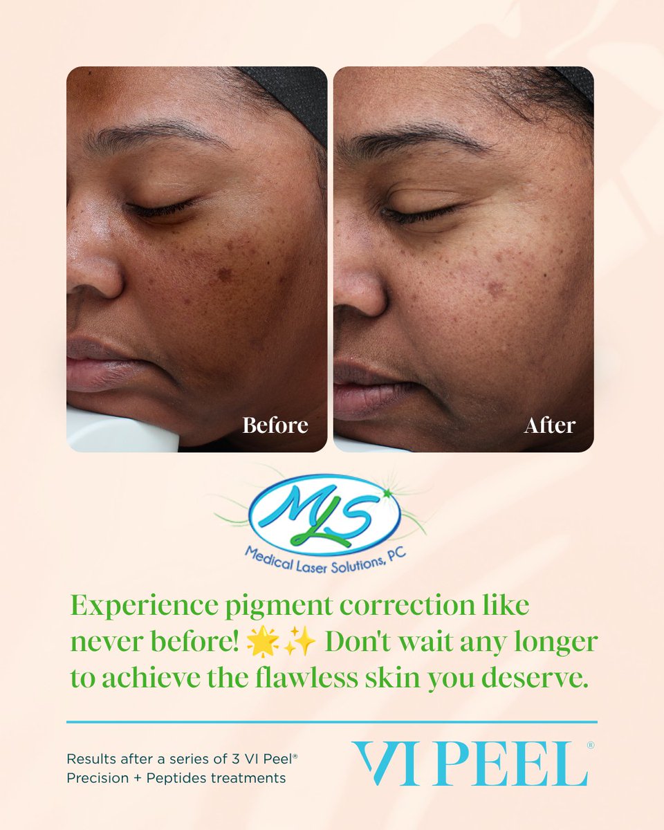 MedLaser's tweet photo. ✨ Check out this amazing before and after! Transform your skin with our VIPEEL treatment. Book your consultation with Lisa at 📞 (781) 762-2800! 

👉 https://t.co/AjnZ3tbNvN

#VIPEEL #SkinTransformation #BeforeAndAfter #BeautyMagic #SkincareGoals #Consultation #MedSpa https://t.co/tp9h7r4HI7